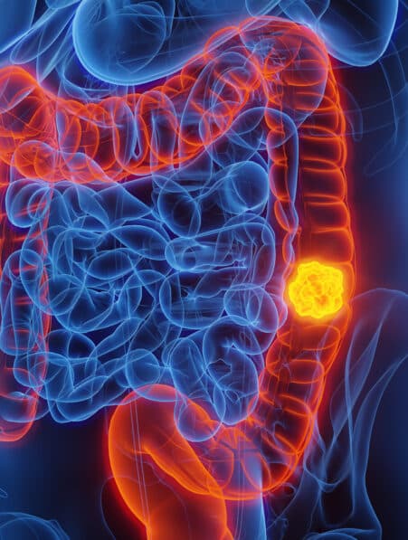cancer colorectal moins 50 ans