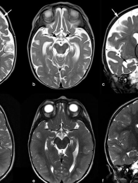 vitamine b12 apport recommande insuffisant pour cerveau etude revele lien avec declin neurologique couv