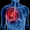 alimentation cancer poumon lien