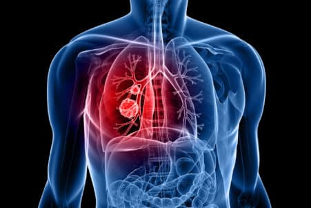 alimentation cancer poumon lien