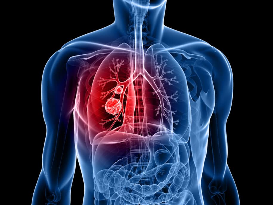 alimentation cancer poumon lien